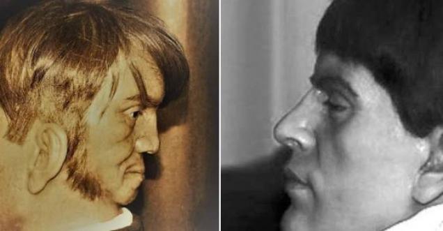 Truth about skull of Edward Mordrake, the man born with a second face on the back of his head