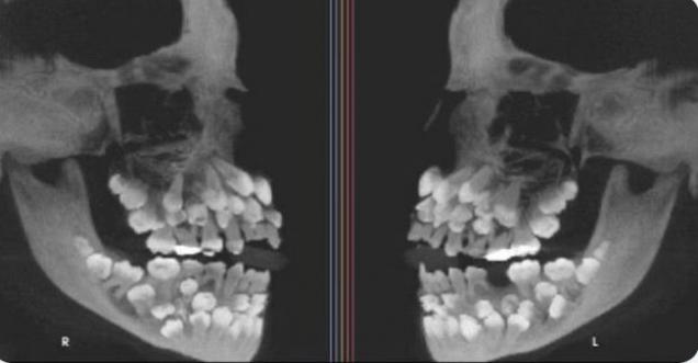 x-ray of a skull with surplus teeth Toddler skull X-rays are terrifying