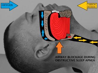 How to avoid heart attack while sleeping- Sleep Apnea?