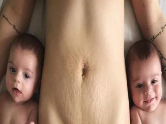 Woman uploads post-baby photo with c-section scar