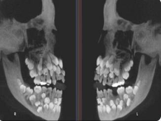 x-ray of a skull with surplus teeth Toddler skull X-rays are terrifying